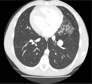 Week 3 CT Chest